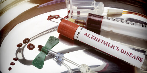 New Blood Test for Alzheimer’s Disease